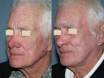 Fraxel repair in conjunction with multiple lasers