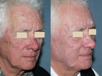 Fraxel repair in conjunction with multiple lasers