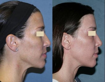 Fraxel repair for sun damage, melasma on face and neck