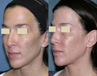 Fraxel repair for sun damage, melasma on face and neck