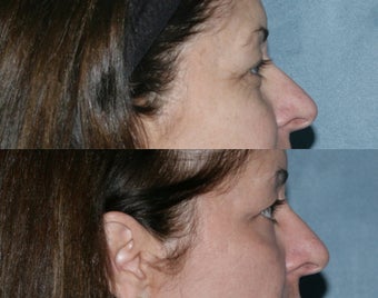 Fraxel Repair