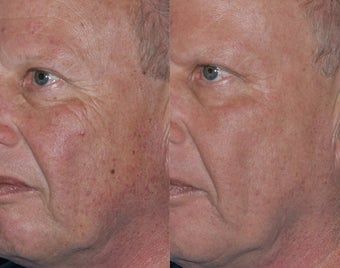 Laser Resurfacing