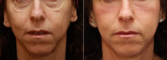 Fraxel Repair for under eye bags
