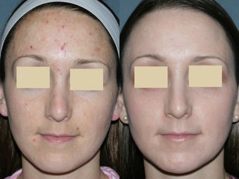 Fraxel Repair for melasma, acne and scars