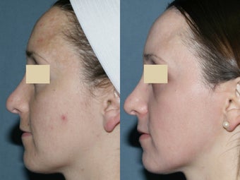 Fraxel Repair for melasma, acne and scars