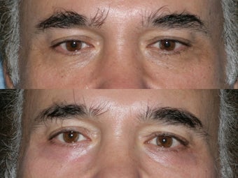 Fraxel Repair for under eye wrinkles