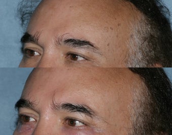 Q-switched alexandrite treatment of age spots