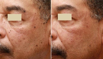 Fraxel Repair 2mm Spot