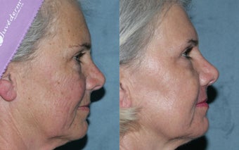 Fraxel Repair in Combination with other lasers