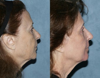 Fraxel Repair in Combination with other lasers yields best results
