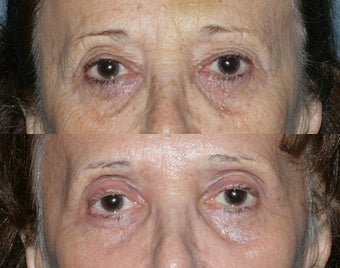 Fraxel Repair in Combination with other lasers yields best results