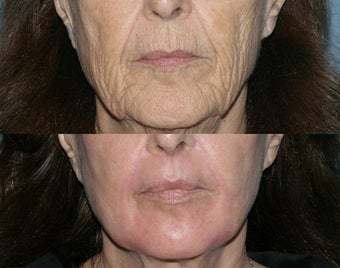 Fraxel Repair in Combination with other lasers yields best results