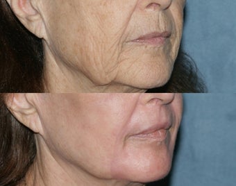 Fraxel Repair in Combination with other lasers yields best results