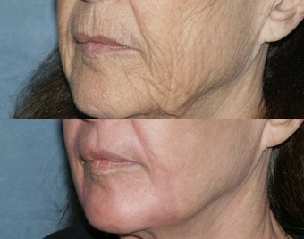 Fraxel Repair in Combination with other lasers yields best results