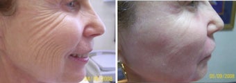 Fraxel Repair
