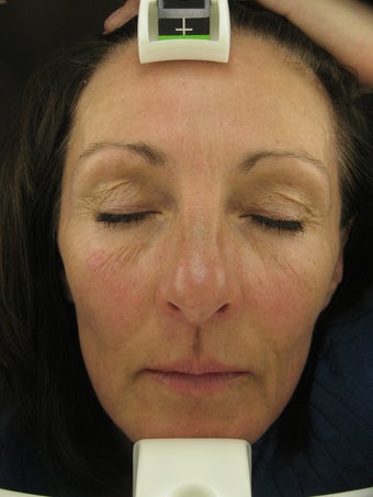 Fraxel re:pair CO2 laser resurfacing treatment