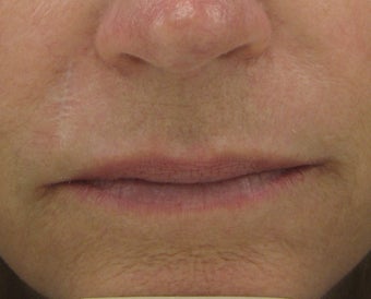 Fraxel re:pair (repair) CO2 laser resurfacing for scar improvement