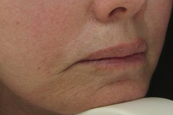 Fraxel Re:pair (repair) CO2 Laser Resurfacing Treatment around the mouth