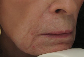 Fraxel repair for Lip, Marionette, and Nasolabial Lines