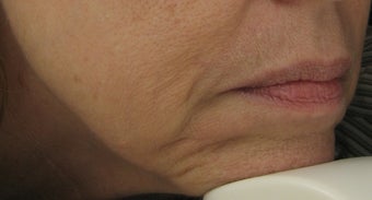 Fraxel re:pair (repair) CO2 laser for Mouth, Jowls, and Lips