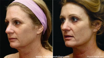 Fraxel CO2 Repair for skin tightening and sun damage