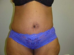40 year old lady with excess skin after gastric bypass