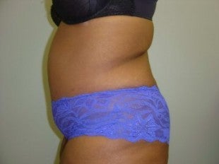 40 year old lady with excess skin after gastric bypass - side view
