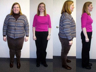 Laparoscopic Roux-en-Y Gastric Bypass