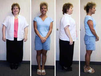 Laparoscopic Roux-en-Y Gastric Bypass