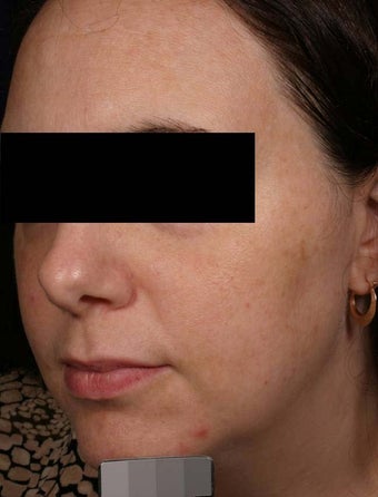 Melasma