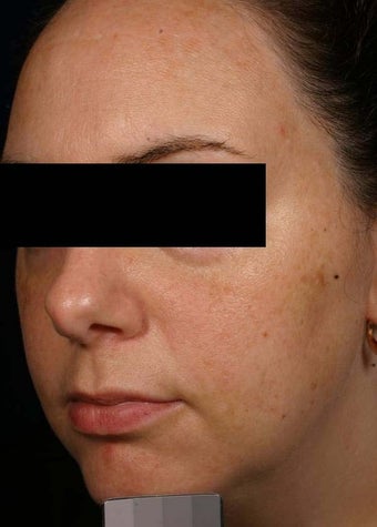 Melasma