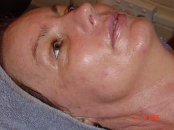 Green peel for acne treatment