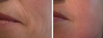 Green Peel to Wrinkles on cheek