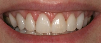 Gum re contouring