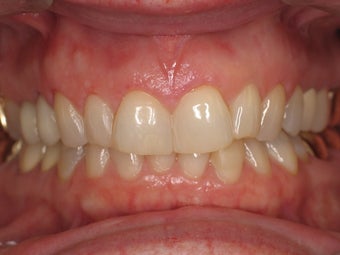 Gum Recontouring