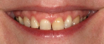 Gum re contouring