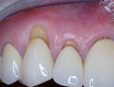 Gum Graft