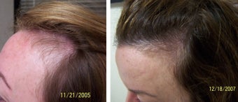 Female medical treatment for hair loss (no surgery)