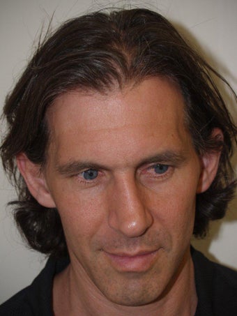 Hair Grafts