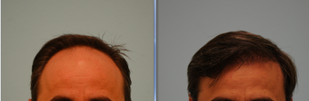 Hair Transplant