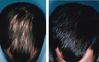 Medical treatment for hair loss (no surgery)