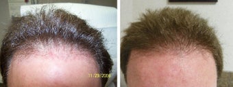 Medical treatment for hair loss (no surgery)