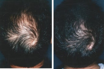 Medical treatment for hair loss (no surgery)