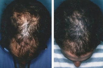 Medical treatment for hair loss (no surgery)