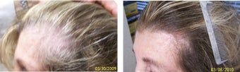 Female medical treatment for hair loss (no surgery)