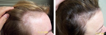 Female medical treatment for hair loss (no surgery)
