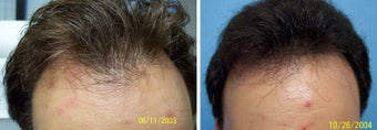 Medical treatment for hair loss (no surgery)