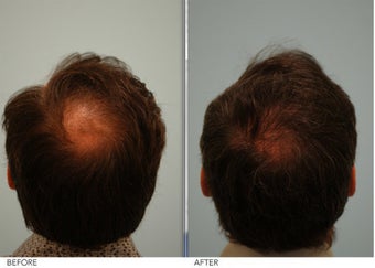 Crown (vertex) Hair Restoration