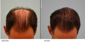 Hair Restoration