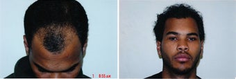 DIFF ANGLES -  Hair Transplant 